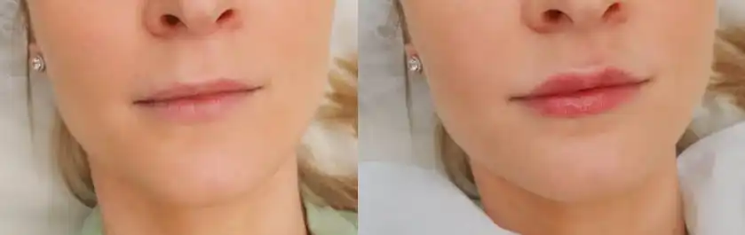 نمونه کار کانتورینگ صورت با تزریق فیلر
