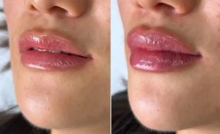 نمونه کار تزریق فیلر لب برای فرم‌دهی طبیعی